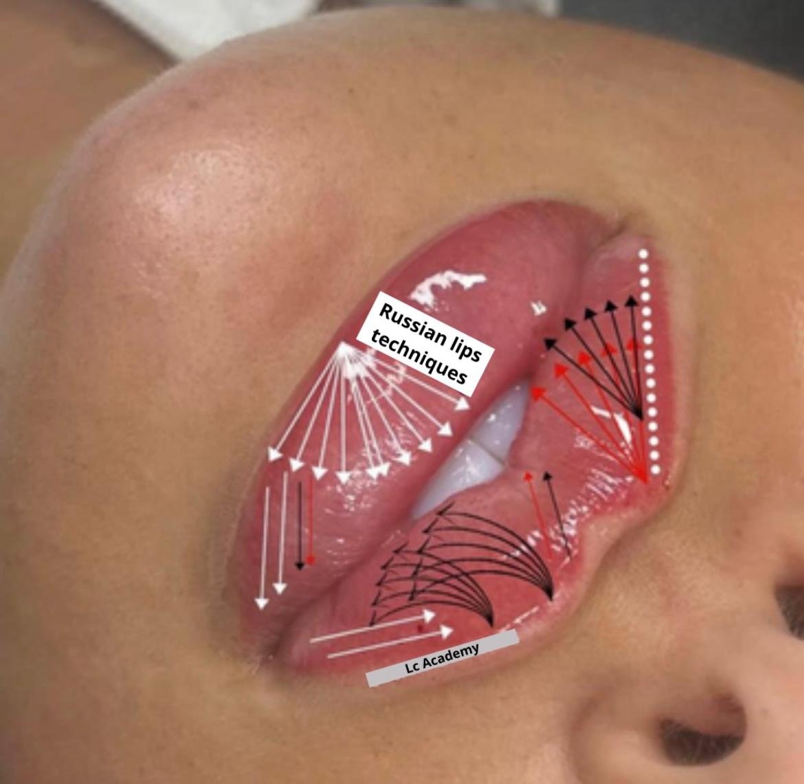 Filler Lips